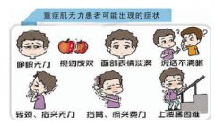 重症肌无力怎么治疗？